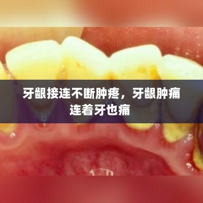 牙龈接连不断肿疼，牙龈肿痛连着牙也痛 