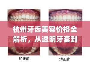 杭州牙齿美容价格全解析，从透明牙套到微笑工程的费用概览