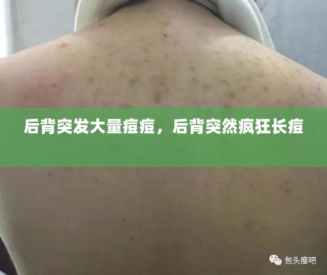 后背突发大量痘痘，后背突然疯狂长痘 